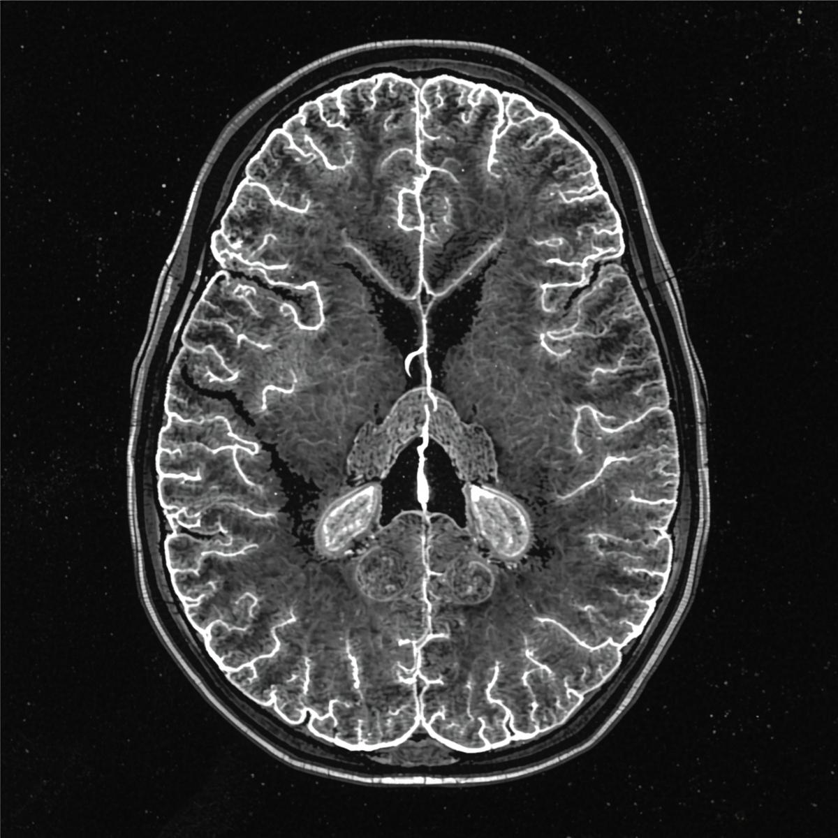 ML Brain Tumor Detection